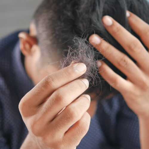 Leczenie łysienia – Laser do stymulacji wzrostu włosów